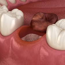 dry sockets after wisdom tooth removal
