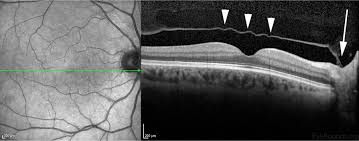 Scar tissue or other tissue pulls the retina away from underlying layers. Vitreous Syneresis An Impending Posterior Vitreous Detachment Pvd