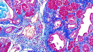 protein causes pancreatic cancer