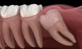 what is the wisdom teeth removal cost