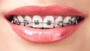 Image result for braces