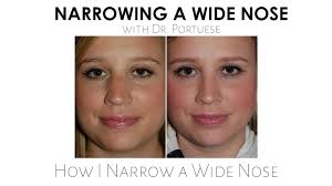 Nose job for wide nose bridge. Watch A Video About Narrowing A Wide Nose Nasal Surgery
