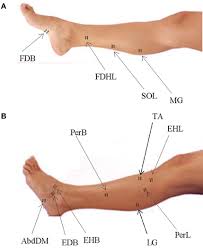 Sites Of Emg Electrode Placement For Muscles In The Foot And