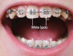 on teeth during orthodontic treatment
