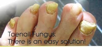 toenail fungus basics