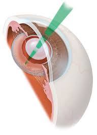 yag capsulotomy procedure top eye