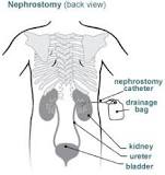 Image result for icd 10 code for nephrostomy tube complication