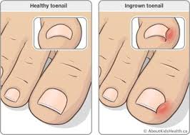 ingrown toenails barrhaven foot care