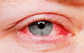 bloodshot eyes how to reduce eye