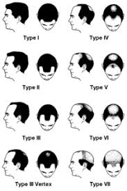 The Norwood Scale How Bald Are You