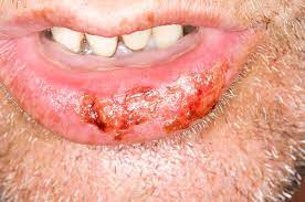cold sores on the lower lip stock