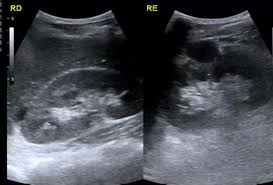La pielonefrite nei neonati, è una infiammazione acuta del rene causata da una infezione di origine batterica. Ecografia Renal Dos Rins O Que E Indicacoes Do Exame Preco