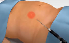 smartlipo laser liposuction in lutz fl