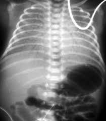 Rds stands for respiratory distress syndrome. it is the most common lung disease in premature infants and it occurs because the baby's lungs are not fully developed. Pediatric Radiology