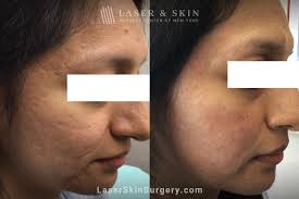 how to treat rolling acne scars laser ny