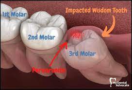 impacted wisdom teeth symptoms causes