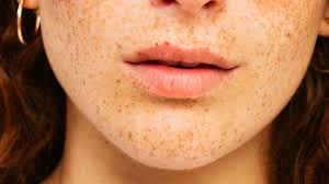 are freckles on lips a cause for