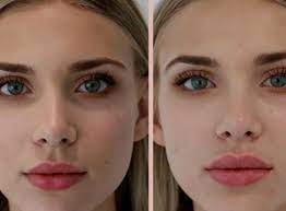lip fillers lip injections beverly