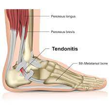 The peroneus longus tendon then continues in a plantar direction along the sole of the foot to the base of the first metatarsal bone. What Is Peroneal Tendonitis Cincinnati Foot Ankle Care