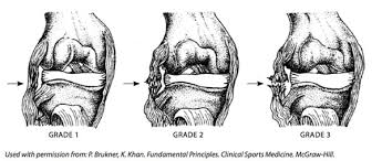 It is not as severe as a grade 3, but definitely more serious than a grade 1 sprain. The Ligament Injury Osteoarthritis Connection The Role Of Prolotherapy In Ligament Repair And The Prevention Of Osteoarthritis Journal Of Prolotherapy