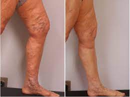 Why vein care is covered by insurance? Can Vein Removal Be Healthy Albuquerque Varicose Veins Albuquerque Vein Laser Institute