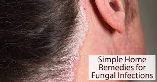 10 home remes for fungal infection