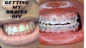 gum swelling after braces