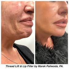 Most insurance programs do not cover elective treatments like facials, botox, fillers, lasers, chemical peels, or any form of microdermabrasion. Thread Lift Vanguard Dermatology