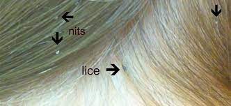 how to check for head lice fresh