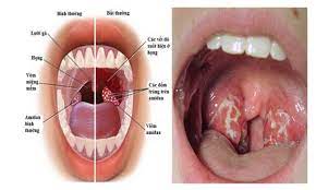 sore throat swollen lymph nodes in the