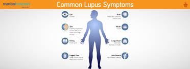 lupus symptoms diagnosis and