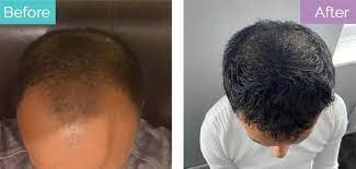 testosterone hair loss does