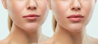 permanent lip enhancement procedure vs