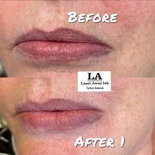 lip tattoo removal all about laser