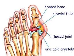 Image result for gout