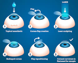 Make sure you're talking to the. Lasik Eye Surgery Conejo Simi Eye Medical Group