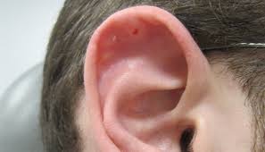 nodule on scaphoid fossa of the ear