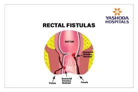 fistula causes symptoms