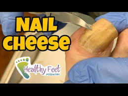fungal toe nail smell like cheese