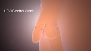 warts shown and explained using