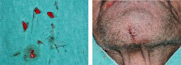 The tract is also cleaned thoroughly of any infected tissue. How To Remove Hair From Pilonidal Sinus