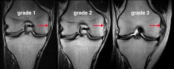 As a general rule, the mcl is not repaired in the general population if it is an isolated injury. Medial Collateral Ligament Injury Mobile Physiotherapy Clinic Ahmedabad Gujarat