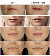 lip enhancement with dermal fillers