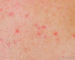 View the profiles of people named hives stress anxiety. What Is A Stress Rash With Pictures