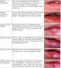 want to know all about cold sores