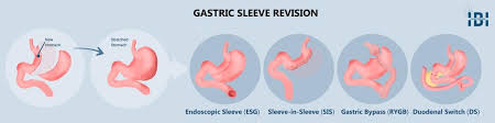 gastric byp gastric sleeve