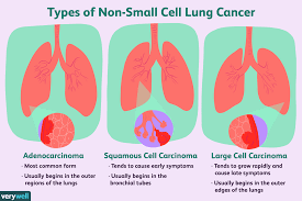 how non small cell lung cancer is treated