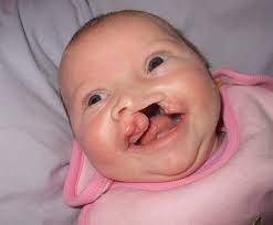 cleft lip palate ociation