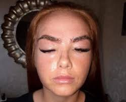 allergic reaction to eyebrow wax