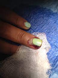 in patients with partial nail avulsion